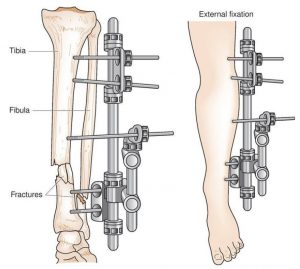 External Fixation Devices